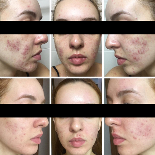 microagulhamento-acne microagulhamento-acne