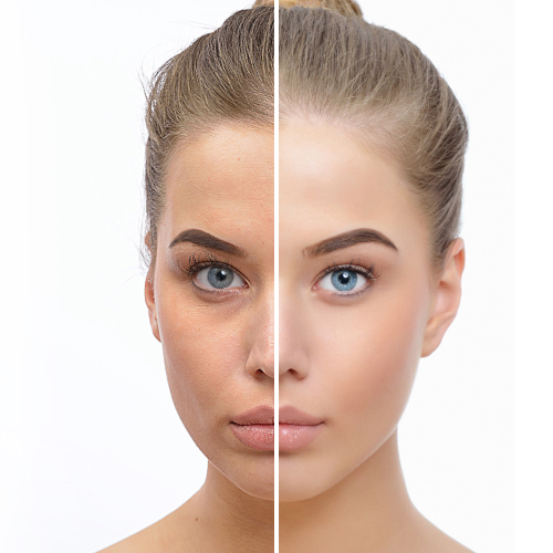 skinbooster-antes-depois